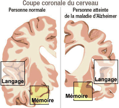http://www.journaldunet.com/science/biologie/dossiers/06/0602-cerveau/images/alzheimer.gif